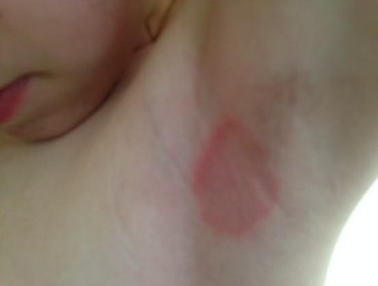 Example of Ringworm (treatmen is Lotrimin)